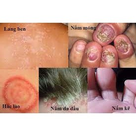 kem bôi hết sạch nấm ngứa, ghẻ nở hắc lào, lang ben, côn trùng đốt, viêm da cơ địa. hết sạch chỉ sau vài ngày