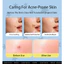 Miếng Dán Mụn Hydrocolloid Hình Ngôi Sao Màu Tàng Hình Hút Mủ Gom Cồi Kháng Khuẩn Thoáng Khí Dễ Trang Điểm Chống Nước Cao Cấp