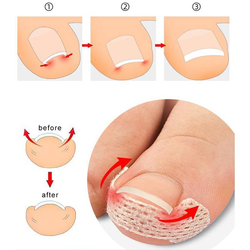 HFSHY 4 / 10 Tờ Dụng cụ làm móng chân mọc ngược Móng chân cho thợ sửa móng tay Paronychia Điều trị Fixer Phục hồi chăm sóc bàn chân Bunion VN