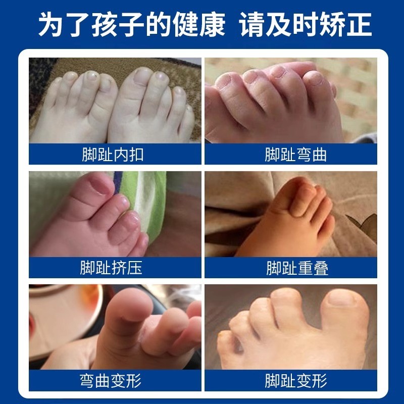 Trẻ sơ sinh Trẻ em Bé Mũi Corrector Ngón chân chồng chéo cong chống rách Ngón tay cái Valgus Ngón chân 25.7.3