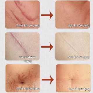 Xóa sẹo nhanh chóng