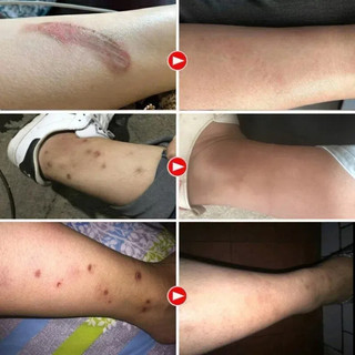 Xóa sẹo nhanh chóng