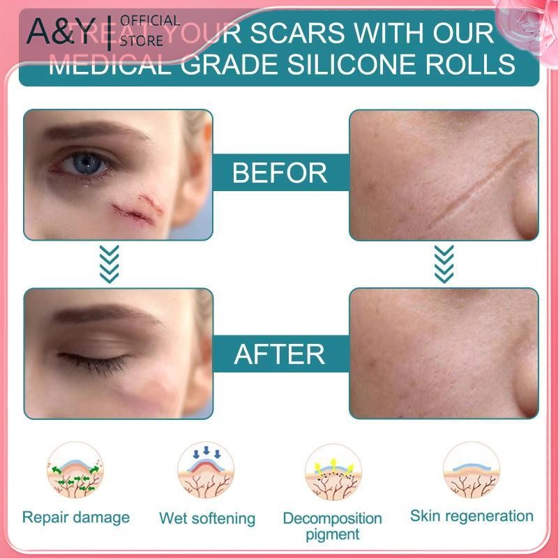 A & Y 1 Cuộn Silicon Gel Scar Sheet Miếng Dán Điều Trị Loại Bỏ Băng Bao Đốt Chấn Thương Sửa Chữa Mụn Tai Sẹo Phần Làm Đẹp Da.