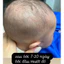 KEM DƯỠNG MLE ATOPALM 100ML