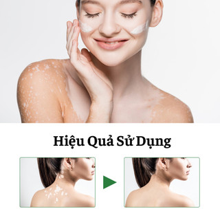 Kem Lang Ben South Moon 20g Hỗ Trợ Dứt Điểm Lang Ben Bạch Biến Loại Bỏ Nấm Ngứa Ngoài Da