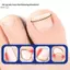 2 Dụng cụ chỉnh sửa móng chân mọc ngược Phục hồi móng chân Nhúng ngón chân Điều trị móng chân mọc ngược chuyên nghiệp Chăm sóc bàn chân