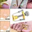 Dụng cụ sửa chữa móng chân mọc ngược phục hồi thiết bị chỉnh sửa móng chân Dụng cụ chăm sóc móng chân
