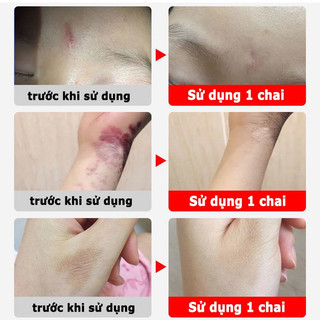 Xóa sẹo nhanh chóng