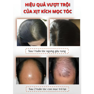 Tinh Chất Mọc Tóc Nhân Sâm SKINZE CQRZEN - Xịt  Kích Mọc Tóc, Giảm Rụng Tóc, Hói Đầu, Dưỡng Nang Tóc Tóc Chắc Khỏe