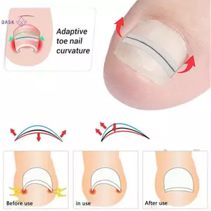 Dụng cụ chỉnh sửa móng chân mọc ngược Kẹp thẳng Nẹp mũi mọc ngược Điều trị móng tay Miếng dán đàn hồi Dụng cụ làm móng chân Stier