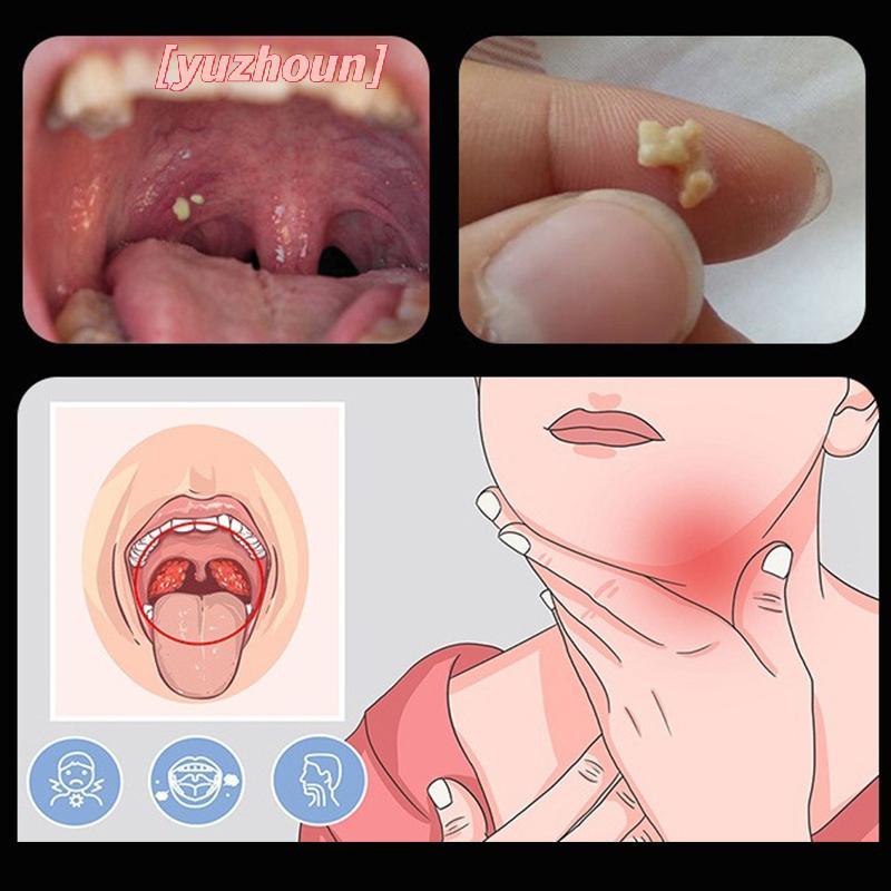 [yuzhoun] Dụng cụ tẩy đá Tonsil Sáp tai Đèn LED Dụng cụ chăm sóc làm sạch miệng bằng thép không gỉ