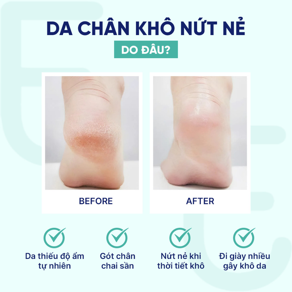 Kem Dưỡng Da Chân Giúp Giảm Nứt Gót EUBOS UREA 10% Cải Thiện Làn Da Khô Thô Ráp Mềm Mịn 100ml