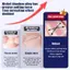 Dụng cụ chỉnh sửa móng chân mọc ngược X Shape Niel Titanium Strip để sử dụng chỉnh sửa móng tay