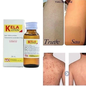 LOTION KELLA VIÊM LỖ CHÂN LÔNG, VIEM DA THÁI LAN