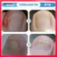 Bộ móng tay mọc ngược để chỉnh sửa móng chân Bộ móng chân bằng vải không dệt Bao gồm cắt móng tay và dải thoáng khí
