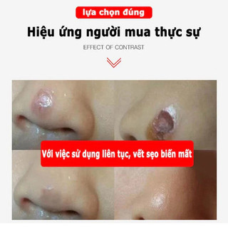 Xóa sẹo nhanh chóng