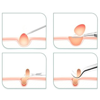 【24H】Bộ Que Nặn Mụn 8 Món Thép Không Gỉ Cao Cấp, Độ Bền Cao, Tay Cầm Chống Trượt, Thiết Kế Tiện Dụng, Lý Tưởng Cho Chăm