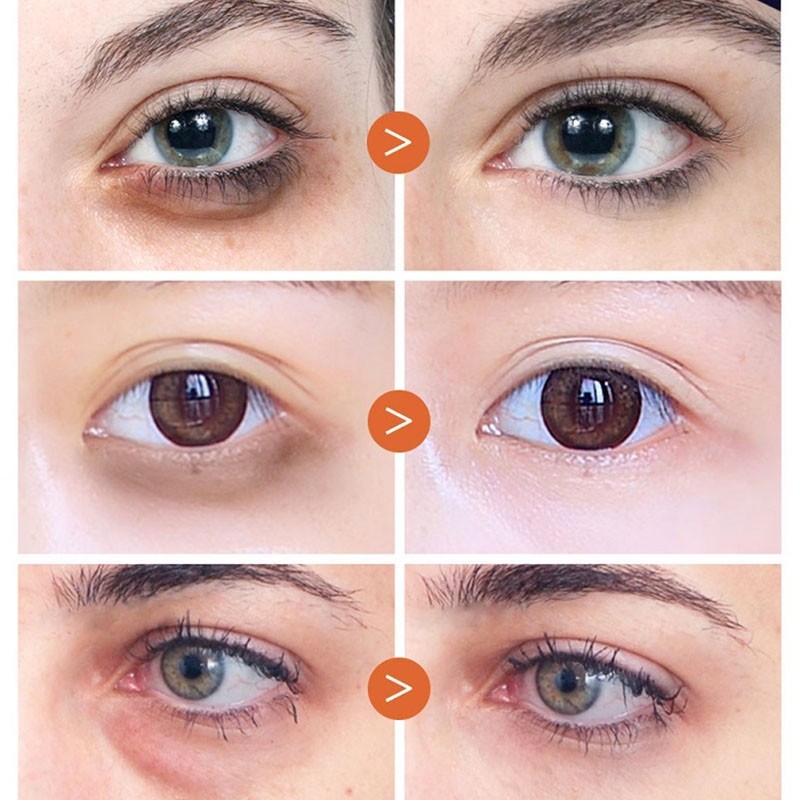 (Chính Hãng) Kem Dưỡng Da Mắt xóa nhăn collagen Đánh Bay Nếp Nhăn, Quầng Thâm,  Bọng Mắt Nếp Nhăn chỉ sau 1 ngày