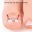 Khung Ảnh Cây Phát Triển Móng Chân Corrector Kẹp Dụng Cụ Nẹp Móng Chân Phục Hồi Nhúng Ngón Chân Điều Trị Móng Tay Chuyên Nghiệp Phát Triển Móng Chân Thẳng VN
