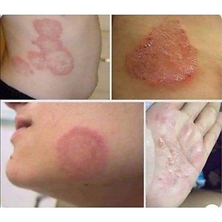 Kem bôi bọ cạp vàng vua các loại nấm ngứa hắc lào, viêm da, tổ đỉa, vẩy nến, á sừng