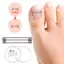 Khung Ảnh Cây Phát Triển Móng Chân Corrector Kẹp Dụng Cụ Nẹp Móng Chân Phục Hồi Nhúng Ngón Chân Điều Trị Móng Tay Chuyên Nghiệp Phát Triển Móng Chân Thẳng VN