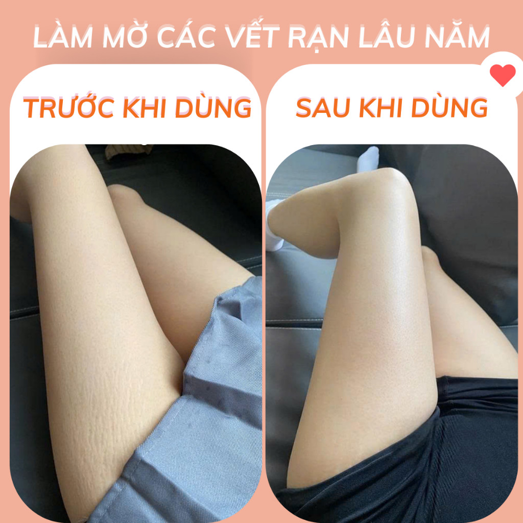 Kem Rạn Da Mờ Cả Rạn Đỏ Rạn Trắng Kutieskin Mama, Giảm Kích Thước Vết Rạn, Mờ Vết Rạn Lâu Năm