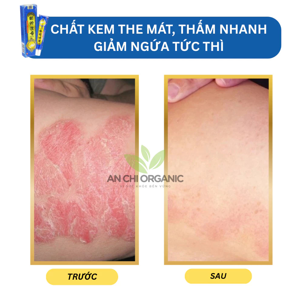 thuốc bôi nấm ngứa,  vẩy nến, á sừng lang ben, viêm da cơ địa,hắc lào - thảo dược tự nhiên[kem xanh]