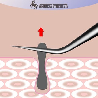Onetimingfine 8CM Cell Mụn Đầu Đen Kẹp Nhíp Thẩm Mỹ Viện Cạo Đặc Biệt Đóng Hiện Vật Hỗ trợ giảm mụn Dụng Cụ VN