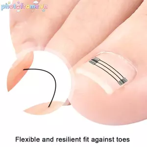 Khung Ảnh Cây Phát Triển Móng Chân Corrector Kẹp Dụng Cụ Nẹp Móng Chân Phục Hồi Nhúng Ngón Chân Điều Trị Móng Tay Chuyên Nghiệp Phát Triển Móng Chân Thẳng VN