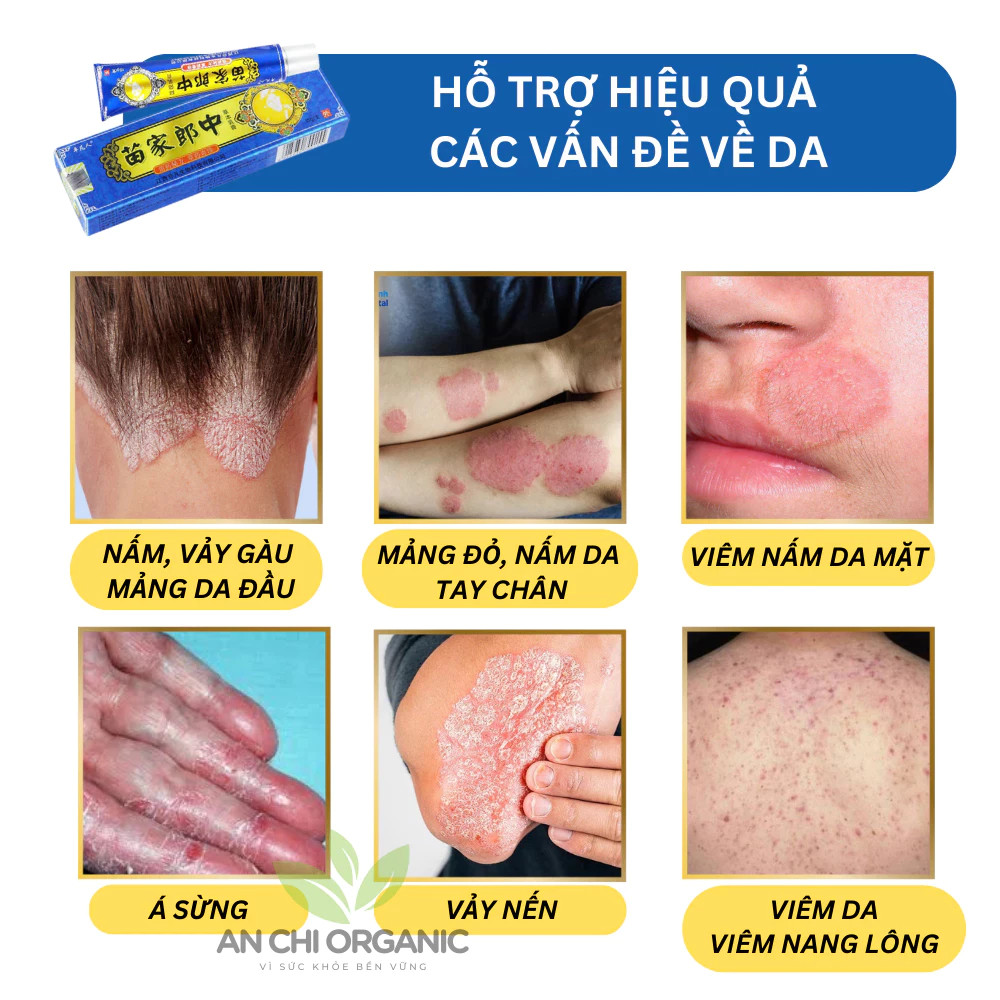 thuốc bôi nấm ngứa,  vẩy nến, á sừng lang ben, viêm da cơ địa,hắc lào - thảo dược tự nhiên[kem xanh]