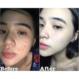 [Chính hãng]Serum loại bỏ mụn mờ thâm peel acnes blanc h 20ml