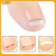 VFZ Dụng cụ chỉnh sửa móng chân mọc ngược Phục hồi móng chân Nhúng ngón chân Điều trị móng chân mọc ngược chuyên nghiệp Dụng cụ chăm sóc bàn chân Louislifecool