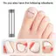 Khung Ảnh Cây Phát Triển Móng Chân Corrector Kẹp Dụng Cụ Nẹp Móng Chân Phục Hồi Nhúng Ngón Chân Điều Trị Móng Tay Chuyên Nghiệp Phát Triển Móng Chân Thẳng VN