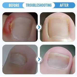Bộ chỉnh sửa móng chân mọc ngược chuyên nghiệp với miếng dán chỉnh sửa móng tay mọc ngược thoáng khí dải chỉnh sửa móng chân cong dụng cụ làm móng chân không đau và dụng cụ nâng chân cho nữ 1 Bộ