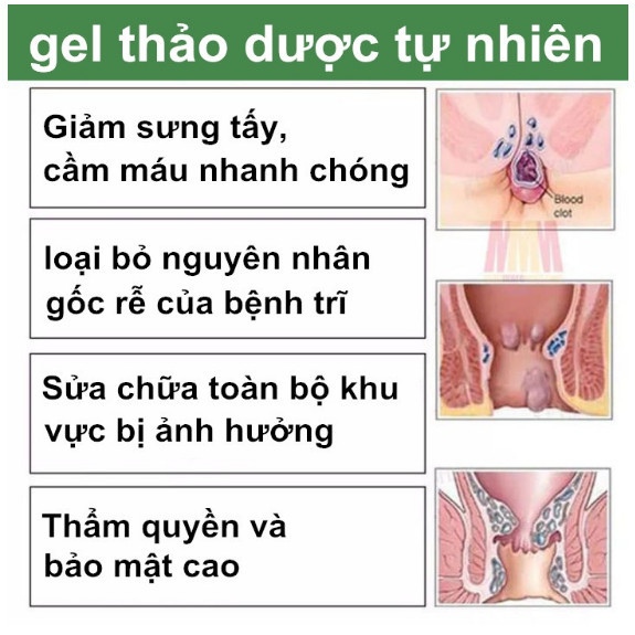 Kem Bôi Trĩ Nhật Bản SHORIN-Kem SHORIN Cải Thiện Tình Trạng Trĩ Ngoại Trĩ Nội Ngoại