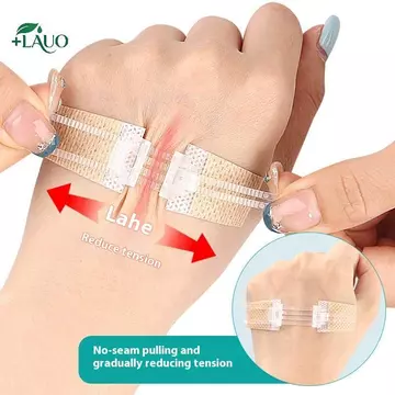 Springevenstar Dây Kéo Dây Buộc Vết Thương Miếng Dán Tĩnh Điện Miếng Dán Vết Thương Nhanh Không Vết Thương Dây Kéo Ngoài Trời Ban Nhạc-Aid Di Động Qui Chép Springevenstar