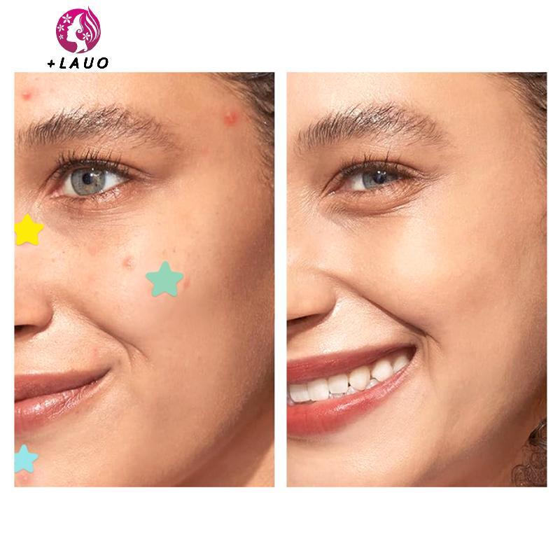 Springevenstar 51 CÁI Miếng dán Hỗ trợ giảm mụn Chăm sóc da mặt Phai màu vết thâm Dấu vết mụn Đóng mụn Blemishes Bao mụn Mụn Sửa chữa mụn trứng cá Springevenstar