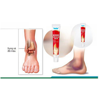 combo 2 Kem Bôi Giúp Giảm Đau Nhức Các Khớp Ngón Chân, Ngón Tay, Giúp Nhanh Chóng Giảm Viêm Xương Khớp Trên Cơ Thể