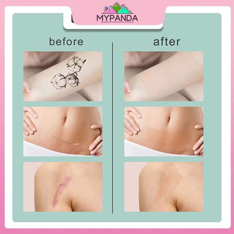 MYPANDA 1 Cuộn Màu Da Che Khuyết Điểm Hình Xăm Stiers Che Khuyết Điểm Hình Xăm Burn Scar Birthmark Miếng Dán Vô Hình Băng Chống Thấm Nước.