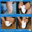 Gel y tế Prosthetic So - thoáng khí, co giãn, hút mồ hôi, mềm mại dành cho người bị cụt chi