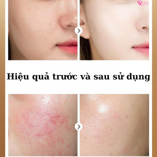 Tinh Chất Chống Nhăn, Giảm Thâm Mụn, Ngừa Lão Hóa, Tăng Độ Đàn Hồi Da, Cải Thiện Sắc Tố Da