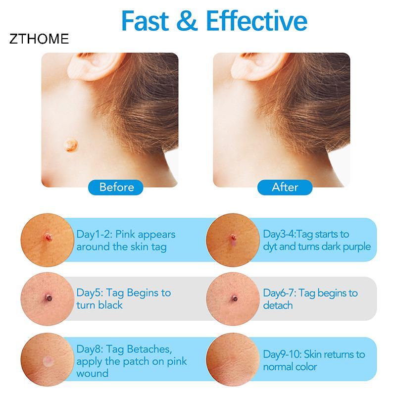 ZTHOME Skin Tag Remover Kit Micro Skin Tag Removal Device Người lớn Mole Stain Wart Remove Face Care Beauty Tools HOT