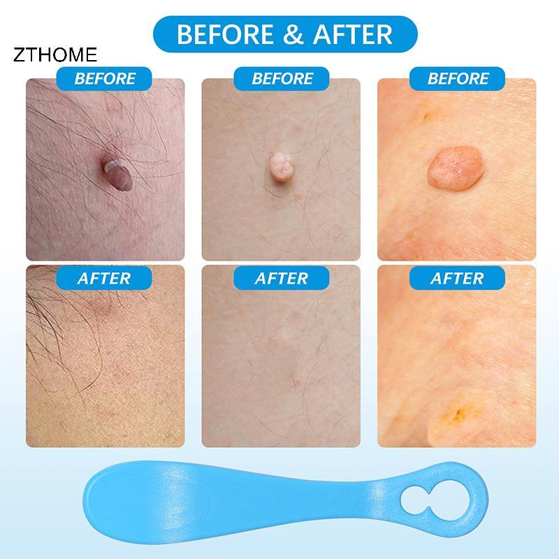 ZTHOME Skin Tag Remover Kit Micro Skin Tag Removal Device Người lớn Mole Stain Wart Remove Face Care Beauty Tools HOT