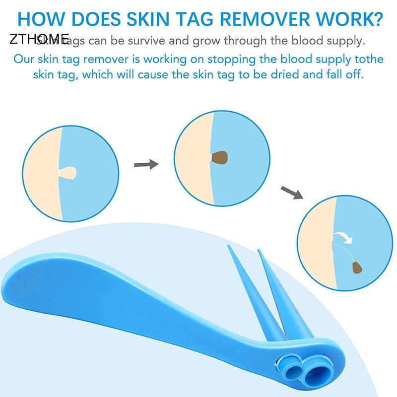 ZTHOME Skin Tag Remover Kit Micro Skin Tag Removal Device Người lớn Mole Stain Wart Remove Face Care Beauty Tools HOT