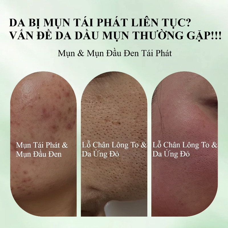 WithUpure Gel Giảm Mụn 50g - Mờ Thâm Dưỡng Trắng - Phù Hợp Dầu Thành Phần Nhẹ Nhàng, Không Gây Kích ứng