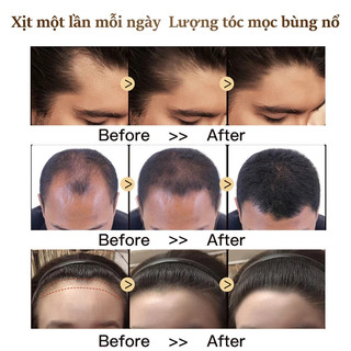Dầu gội kích thích mọc tóc Dầu gội mọc tóc Giảm Gãy Rụng Dầu Gội Mọc Tóc Nhanh kiểm soát dầu loại bỏ gàu