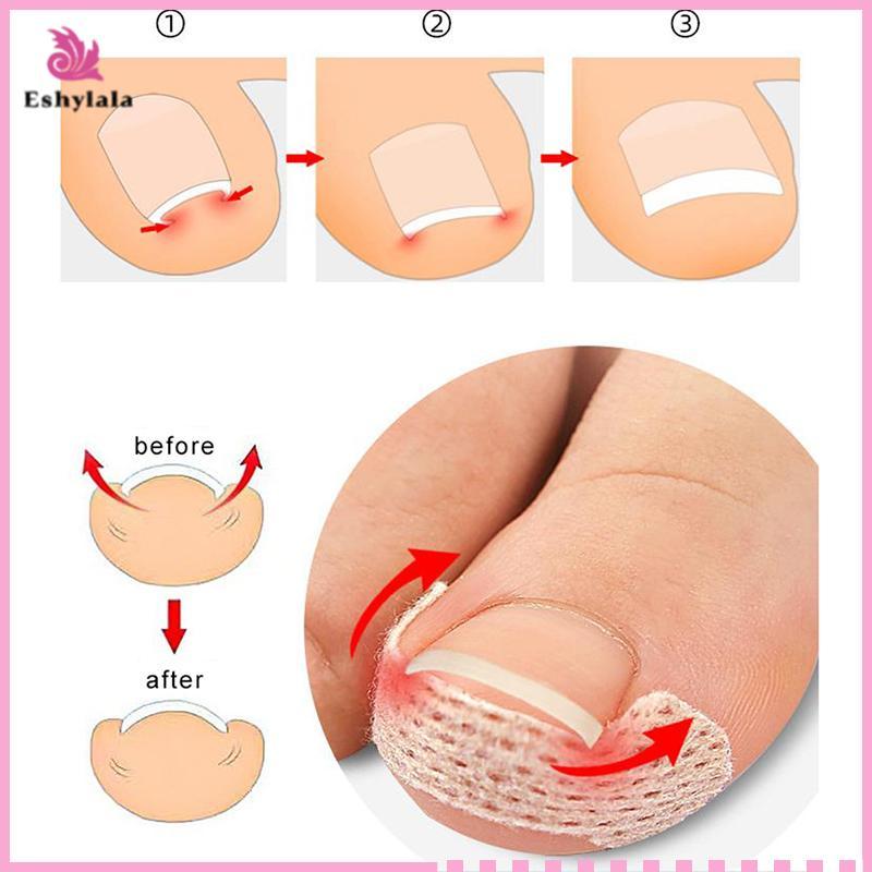 Eshylala 4 / 10 Tờ Dụng cụ làm móng chân mọc ngược Móng chân Stiers cho dụng cụ chỉnh sửa móng tay Paronychia Treatment Fixer Recover Bunion Feet Care [MỚI]