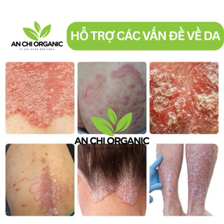 Kem Bôi Nấm Ngứa Viêm Da Cơ Địa NHẬT BẢN XANH LÁ*** Hắc Lào, Tổ Đỉa, Vẩy Nến, Á Sừng, Lang Ben An Chi Organic