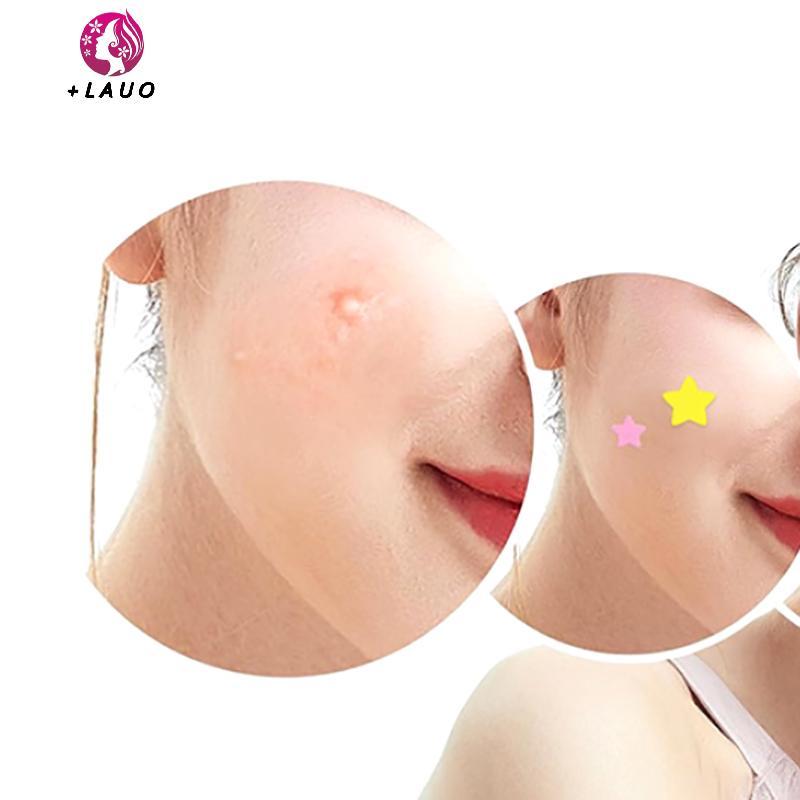 Springevenstar 51 CÁI Miếng dán Hỗ trợ giảm mụn Chăm sóc da mặt Phai màu vết thâm Dấu vết mụn Đóng mụn Blemishes Bao mụn Mụn Sửa chữa mụn trứng cá Springevenstar