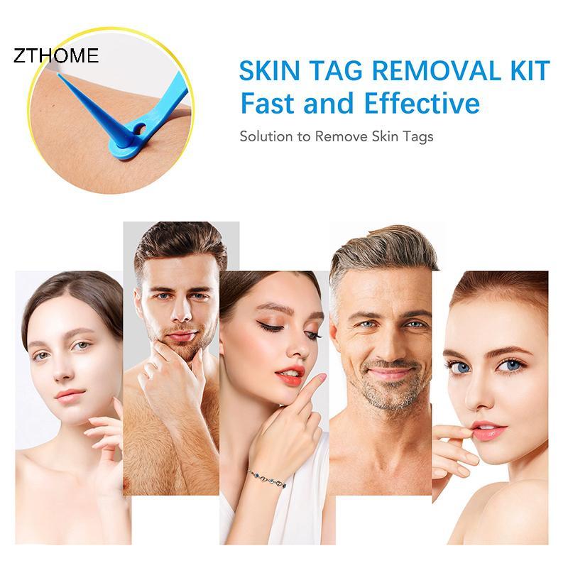 ZTHOME Skin Tag Remover Kit Micro Skin Tag Removal Device Người lớn Mole Stain Wart Remove Face Care Beauty Tools HOT